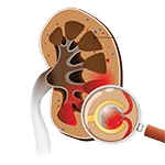 Glomerulonephritis
