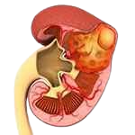 Kidney Cysts