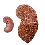 Kidney Damage