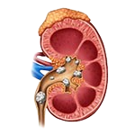Kidney Stone