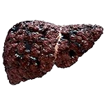Liver Cirrhosis