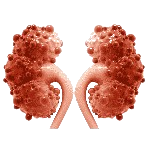 Polycystic Kidney Disease