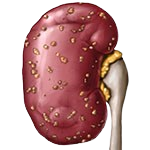 Pyelonephritis