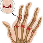 arthrities