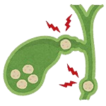 Gallbladder Stone