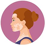 Leukoderma (Vitiligo)